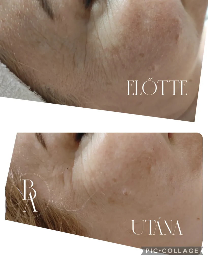 Beauty Art kozmetika Szolnok munkája: a vendég szem körüli területe anti-aging kezelés előtt és után